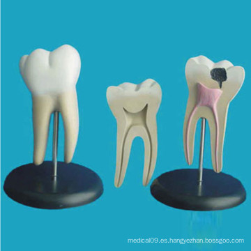 Dientes Molares Patológicos Humanos Modelo Anatómico para la Enseñanza (R080103)